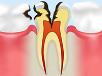C3：神経に達したむし歯