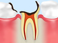 C4：歯根に達したむし歯